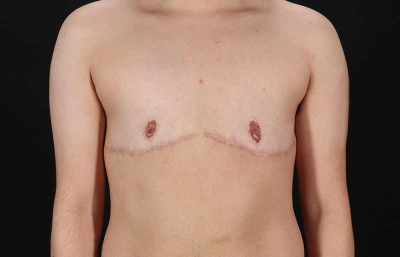 FTM Chest Contouring Before & After Patient #2028