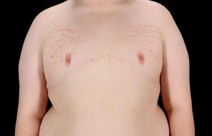 FTM Chest Contouring Before & After Patient #2039