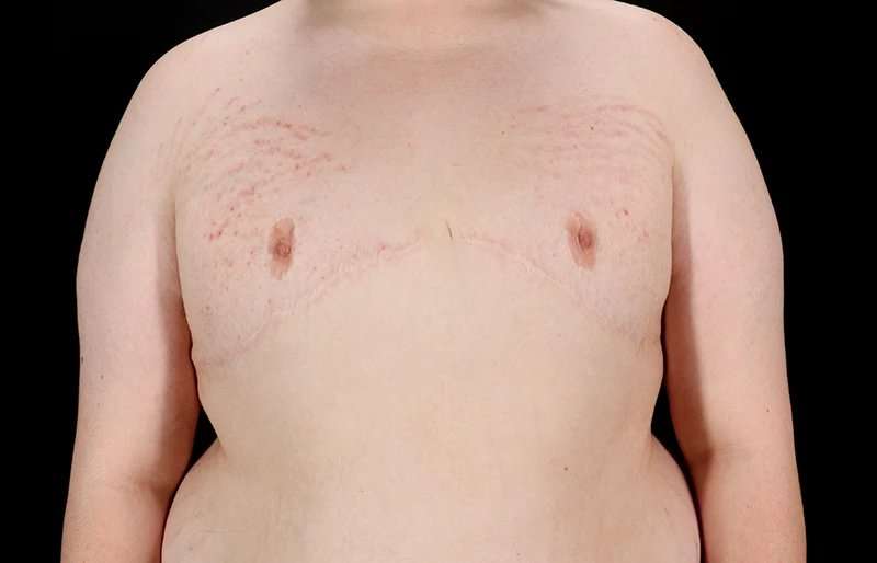 FTM Chest Contouring Before & After Patient #2039