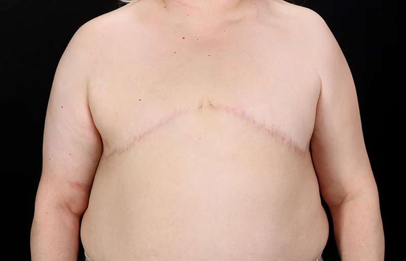 FTM Chest Contouring Before & After Patient #2050