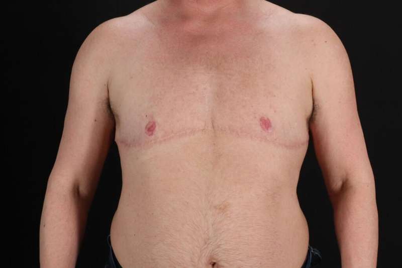 FTM Chest Contouring Before & After Patient #2061