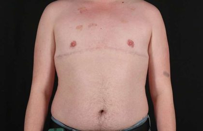 FTM Chest Contouring Before & After Patient #2072