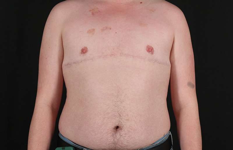 FTM Chest Contouring Before & After Patient #2072