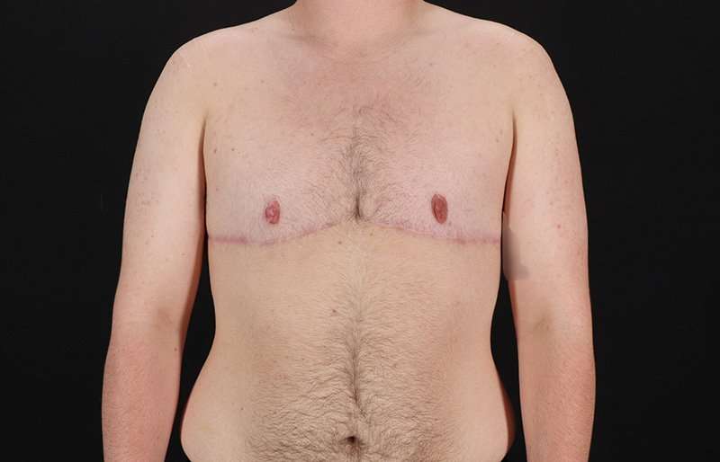 FTM Chest Contouring Before & After Patient #2083