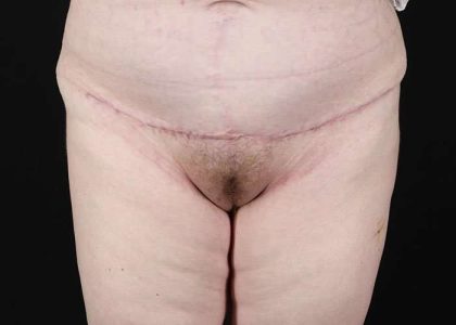 Monsplasty Before & After Patient #2106