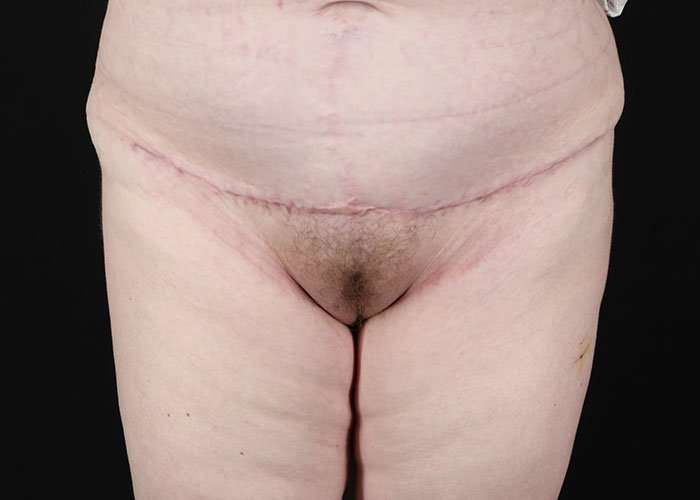 Monsplasty Before & After Patient #2106