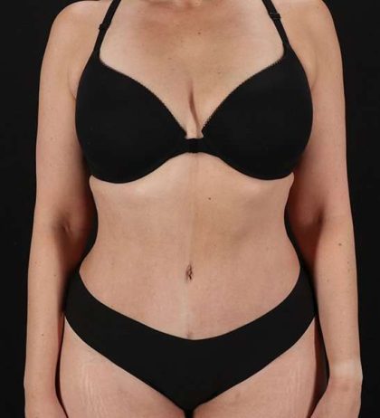 Tummy Tuck Before & After Patient #2128