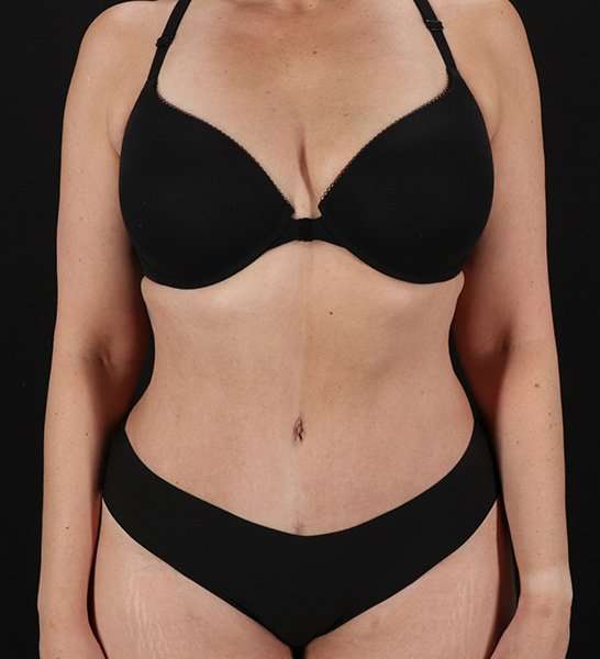 Tummy Tuck Before & After Patient #2128