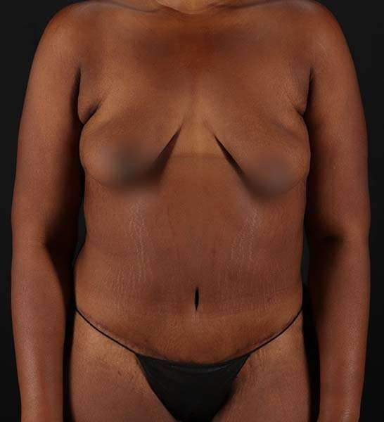 Tummy Tuck Before & After Patient #2139