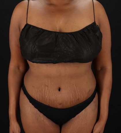 Tummy Tuck Before & After Patient #2146
