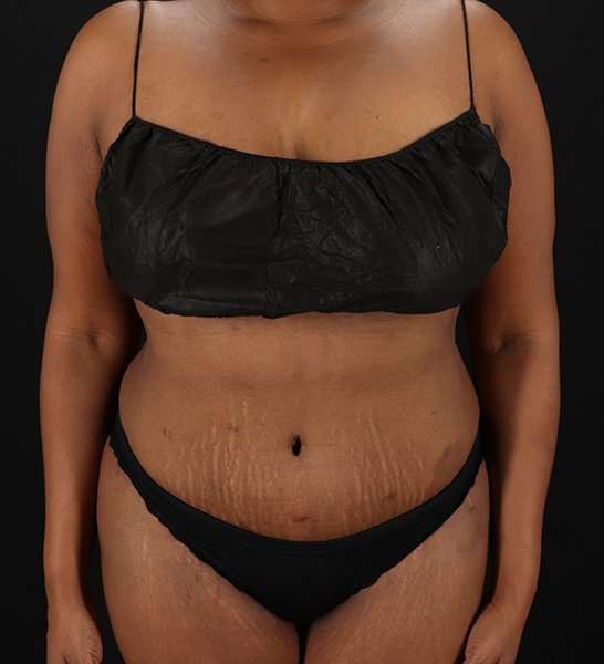 Tummy Tuck Before & After Patient #2146