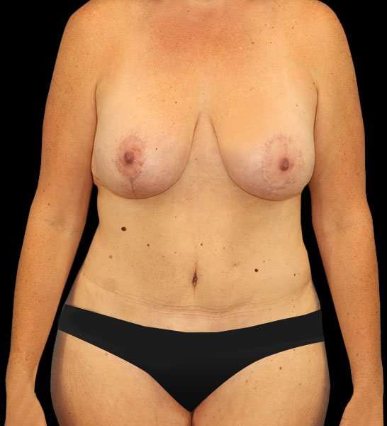 Tummy Tuck Before & After Patient #2157
