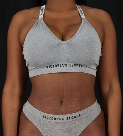 Tummy Tuck Before & After Patient #2168