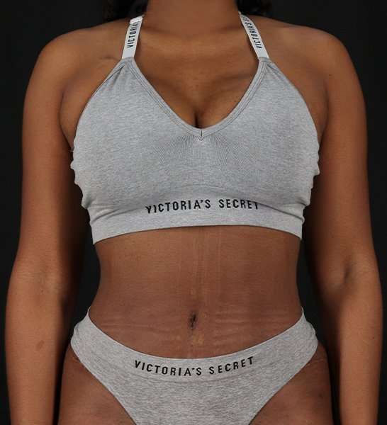 Tummy Tuck Before & After Patient #2168