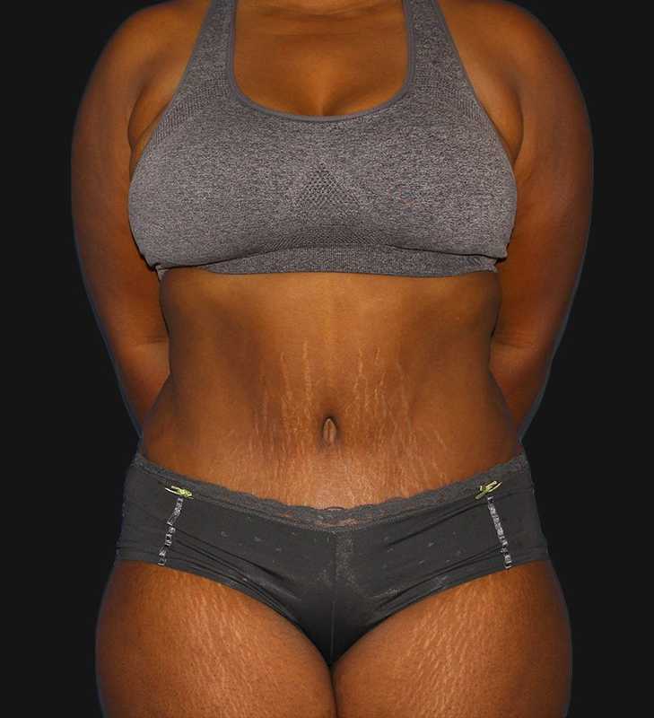 Tummy Tuck Before & After Patient #2179