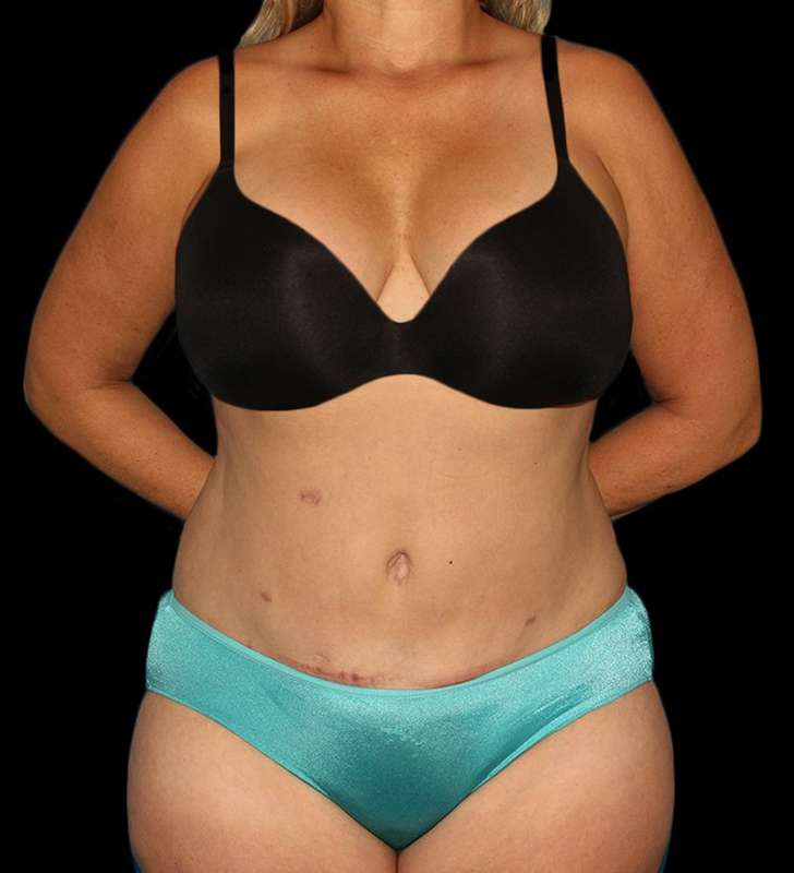 Tummy Tuck Before & After Patient #2190