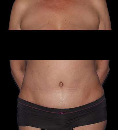 Tummy Tuck Before & After Patient #2201