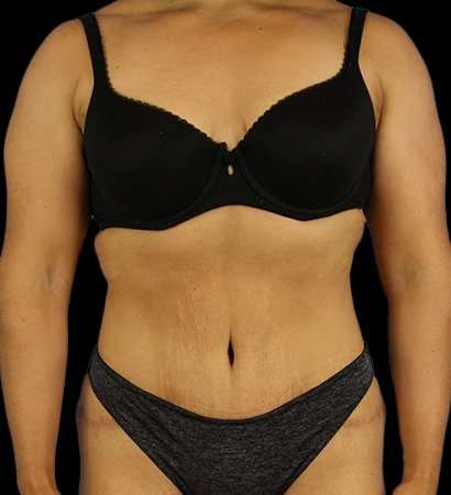Tummy Tuck Before & After Patient #2212