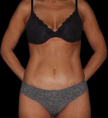 Tummy Tuck Before & After Patient #2269