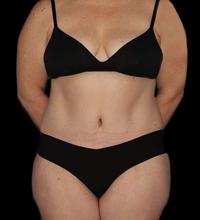 Tummy Tuck Before & After Patient #2280