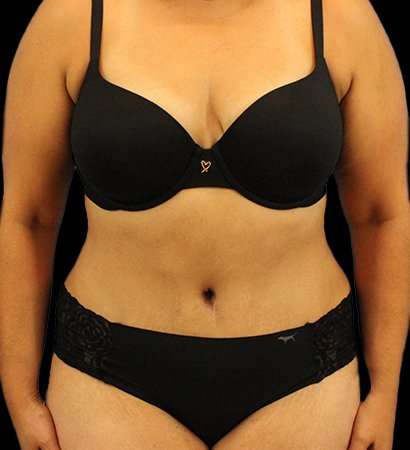 Tummy Tuck Before & After Patient #2291
