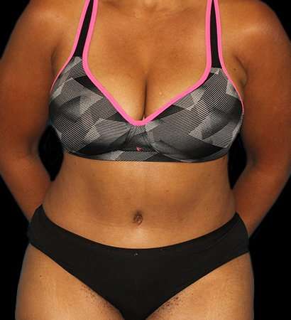Tummy Tuck Before & After Patient #2302