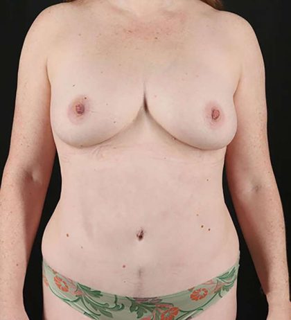 Tummy Tuck Before & After Patient #2313