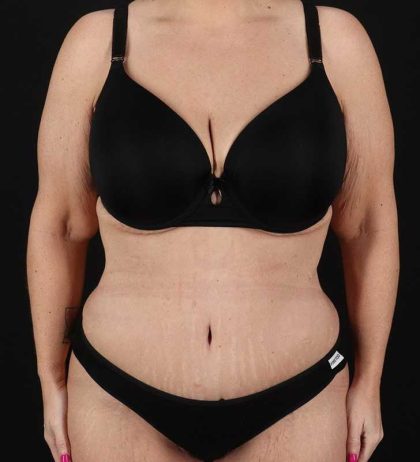 Tummy Tuck Before & After Patient #2326