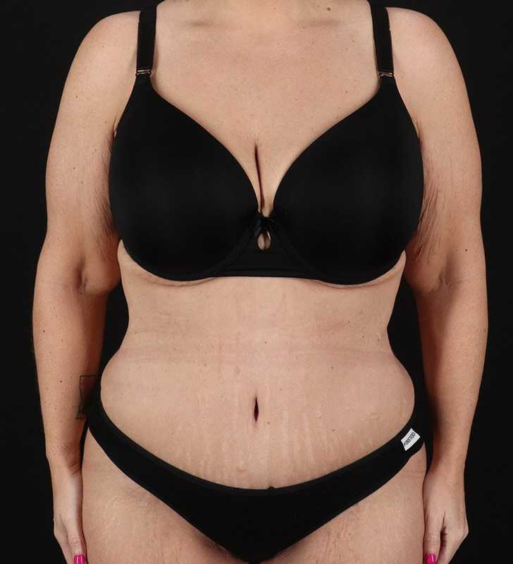 Tummy Tuck Before & After Patient #2326