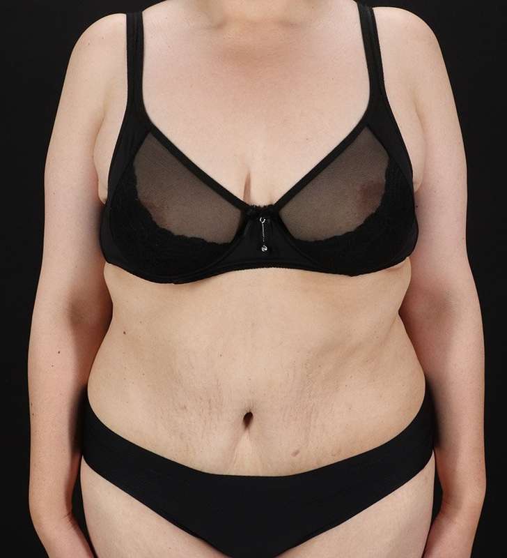Tummy Tuck Before & After Patient #2339