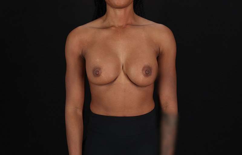 Breast Augmentation - Implant Before & After Patient #1023