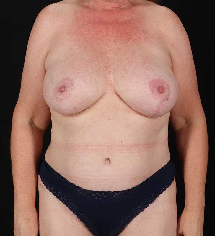 Tummy Tuck Before & After Patient #2376
