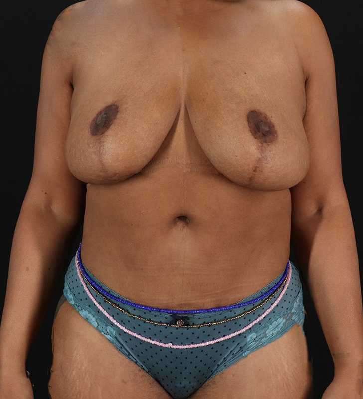 Tummy Tuck Before & After Patient #2402