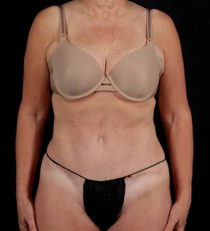 Tummy Tuck Before & After Patient #2435
