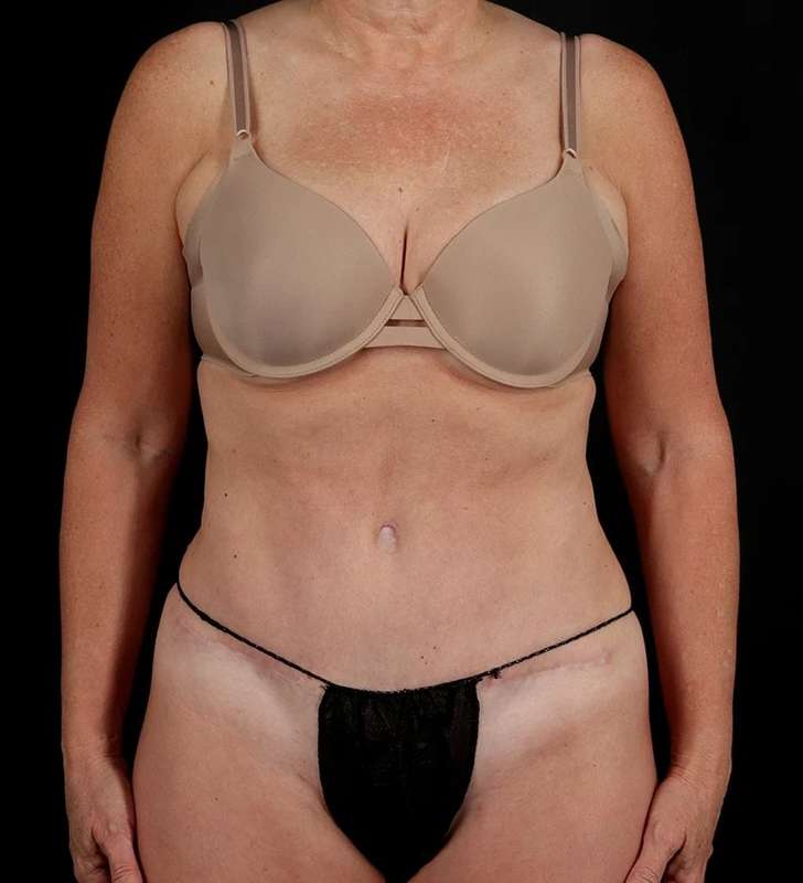 Tummy Tuck Before & After Patient #2435