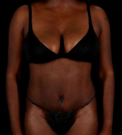 Tummy Tuck Before & After Patient #2448