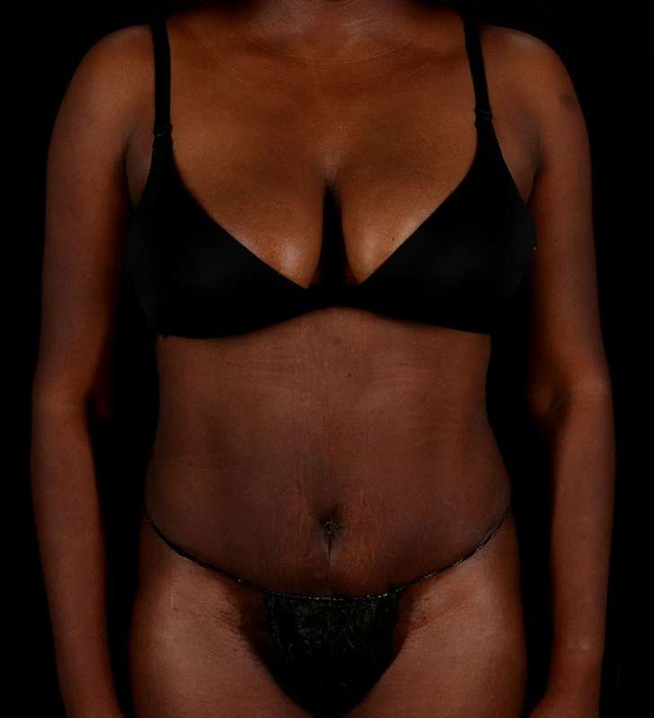 Tummy Tuck Before & After Patient #2448