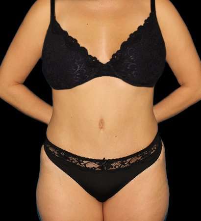 Tummy Tuck Before & After Patient #2485