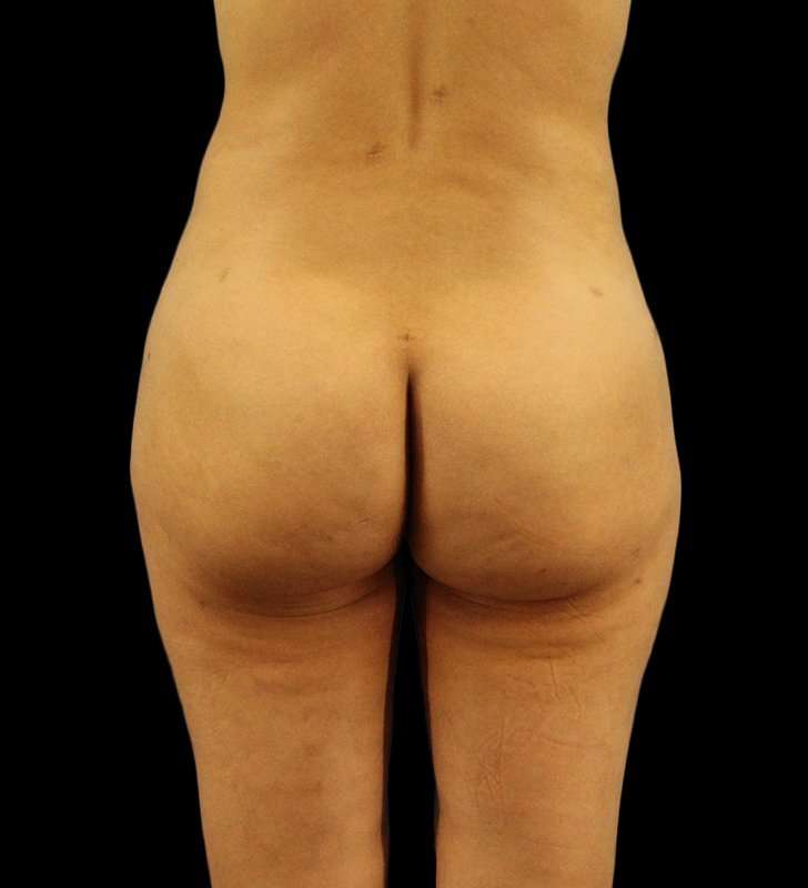 Brazilian Butt Lift Before & After Patient #2496