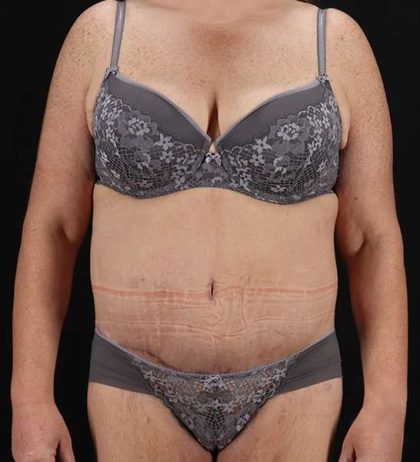 Circumferential Body Lift Before & After Patient #2509