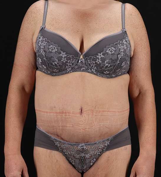 Circumferential Body Lift Before & After Patient #2509