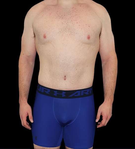 Circumferential Body Lift Before & After Patient #2522