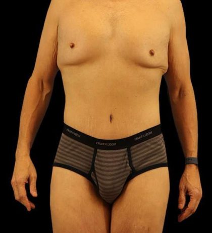 Circumferential Body Lift Before & After Patient #2535