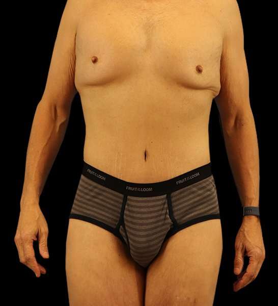 Circumferential Body Lift Before & After Patient #2535