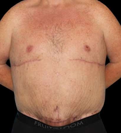Massive Weight Loss Before & After Patient #5155