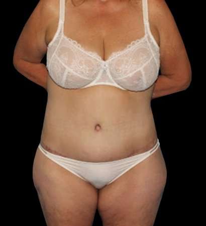 Circumferential Body Lift Before & After Patient #2572