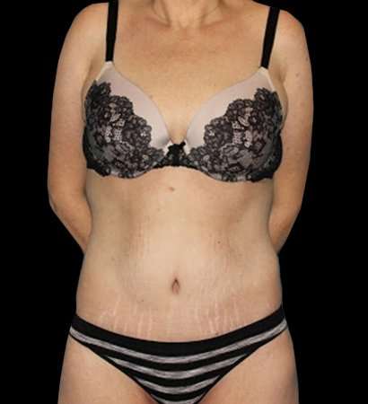 Circumferential Body Lift Before & After Patient #2598
