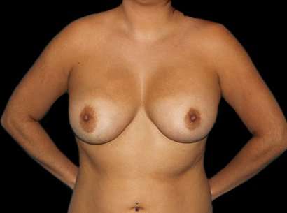 Breast Augmentation - Implant Before & After Patient #1043