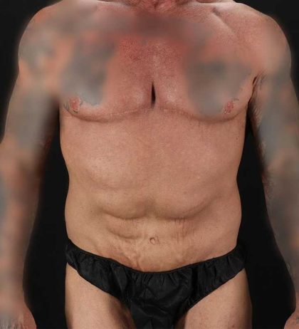 Circumferential Body Lift Before & After Patient #2611