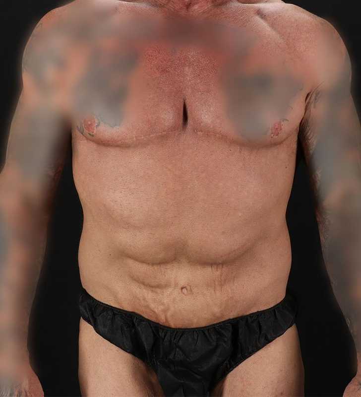 Circumferential Body Lift Before & After Patient #2611